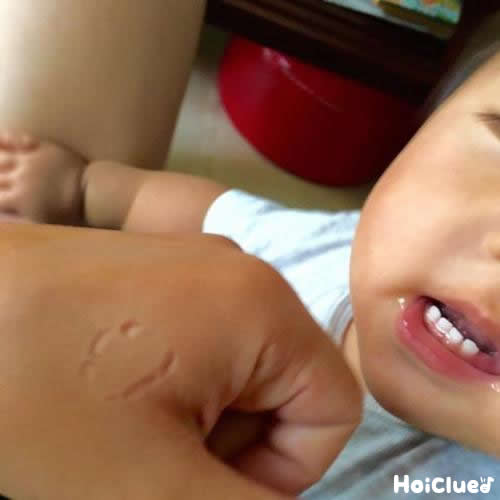 【保健コラム】噛みつきやひっかき傷は「冷やす？」「揉む？」